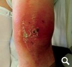 Kniegelenkinfektion nach Endoprothese Kniegelenkinfektion nach Endoprothese